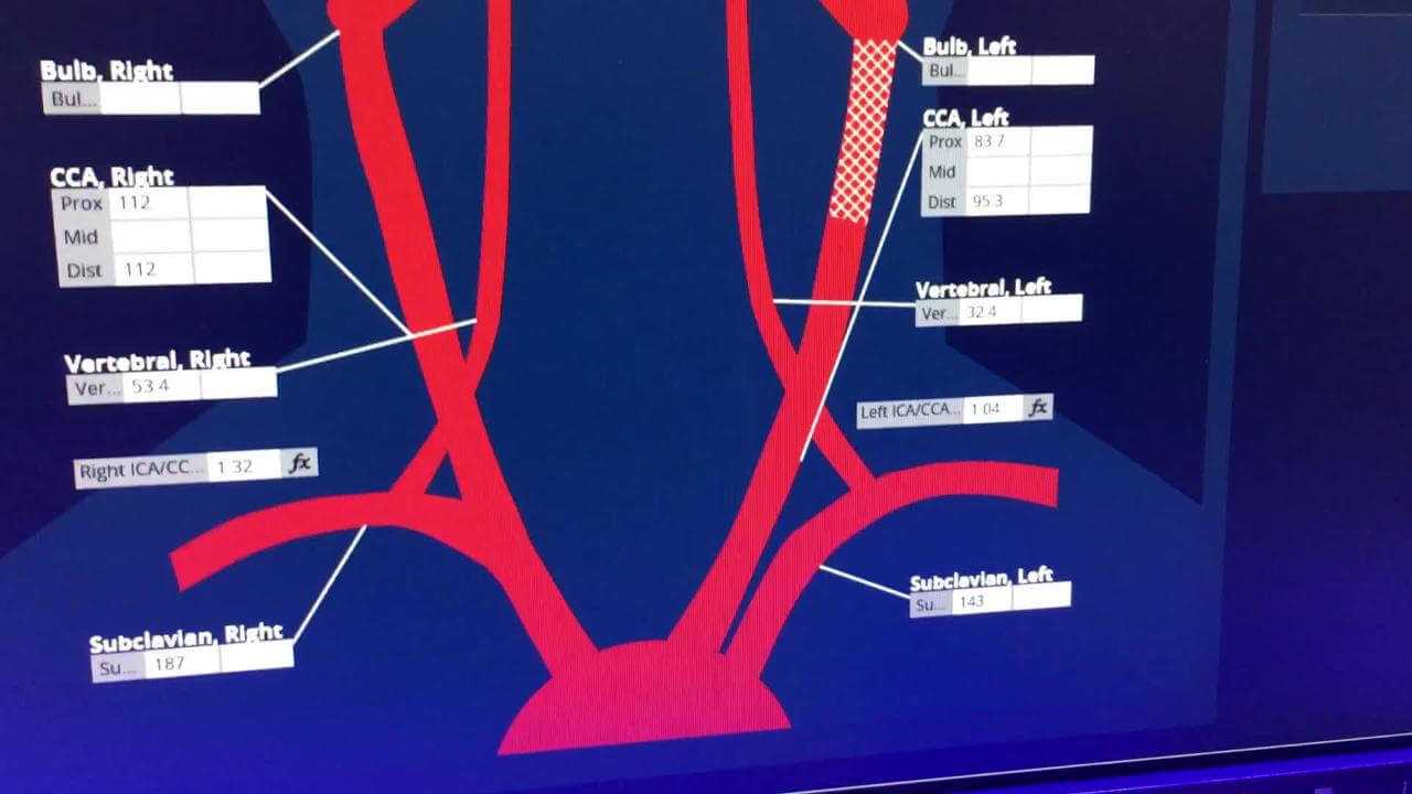 Video: Carotid Artery Reporting Template Example | Daic With Regard To Carotid Ultrasound Report Template